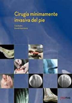 Cirugia Minimamente Invasiva Del Pie
